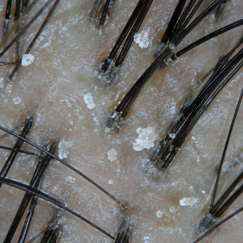 Dandruff illustrative close-up