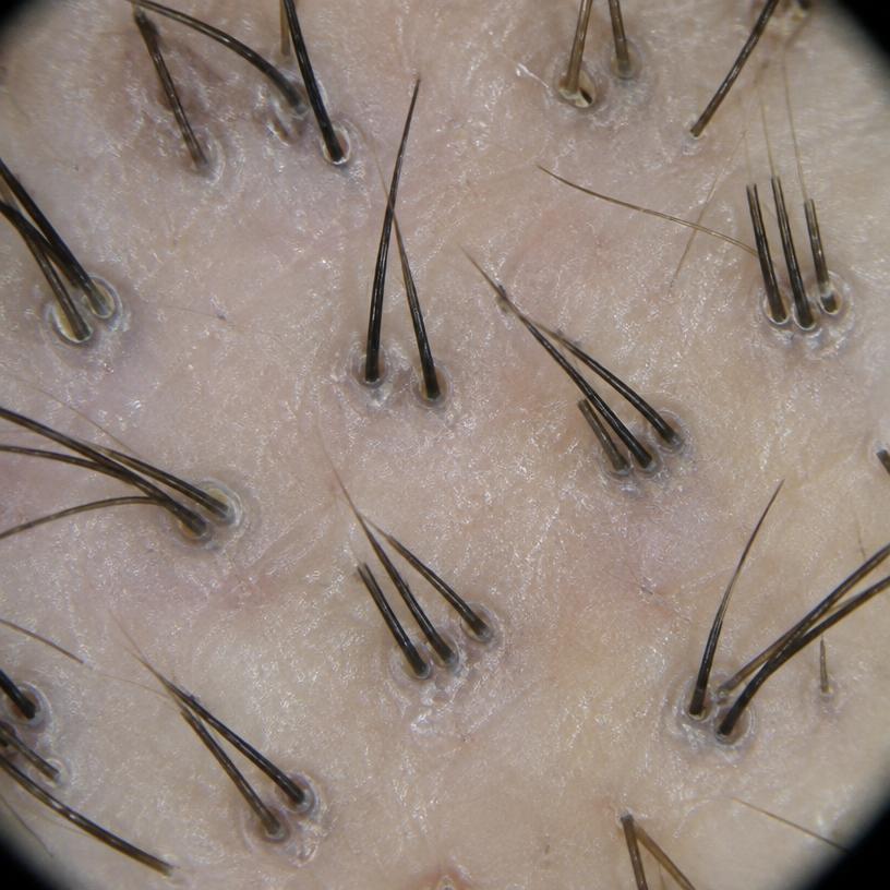 Follicular count illustrative close-up
