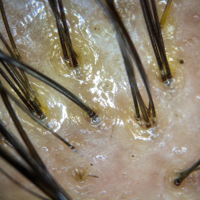 Sebum illustrative close-up