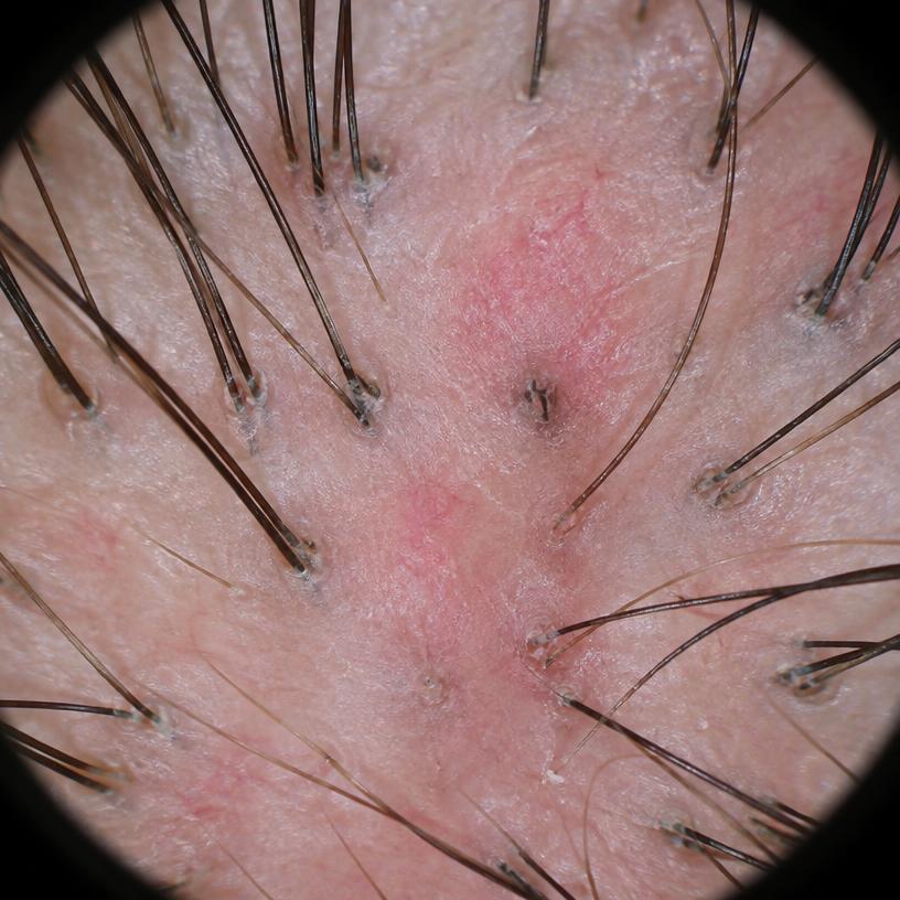 Scalp temp illustrative close-up